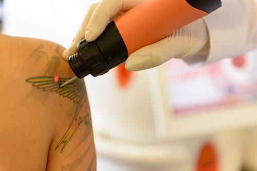 Tattooentfernung mittels Laser